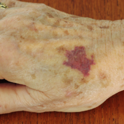 ¿Por qué salen moretones sin golpes en las personas mayores? Causas, señales de alerta y cuidados ante hematomas.