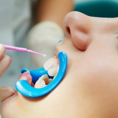 Mitos y verdades sobre los sellantes dentales en niños: qué dice la evidencia y cuándo usarlos.