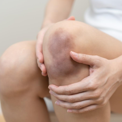 SALUD: Moretones, qué son, cómo tratarlos y cuándo consultar al médico