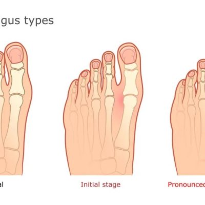 El  20% de la población tiene juanetes, una de las deformidades más habituales del pie.