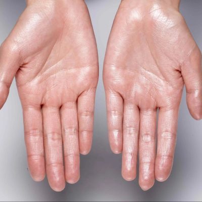 SALUD: Hiperhidrosis: cuando la sudoración o transpiración va más allá de lo normal.