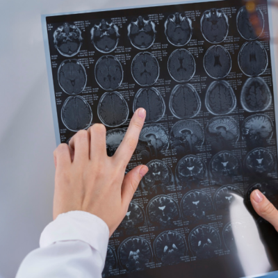 SALUD: Enfermedades del cerebro. ¿ Además del ACV, cuáles son las más comunes en Chile?
