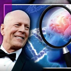 Demencia Frontotemporal (DFT): Bruce Willis visibilizando una enfermedad aún poco comprendida.