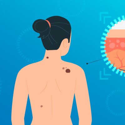 Precisan diagnósticos de cáncer de piel de tipo melanoma con Inteligencia Artificial.
