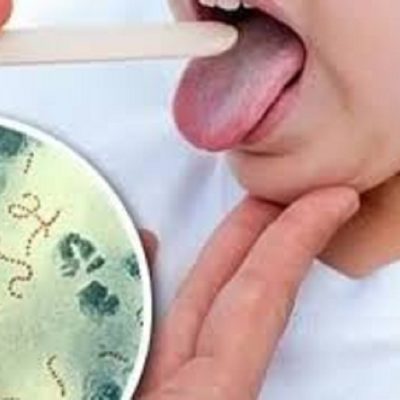 INFLUENZA: Cómo prevenir las infecciones con bacteria streptococcus pyogenes.